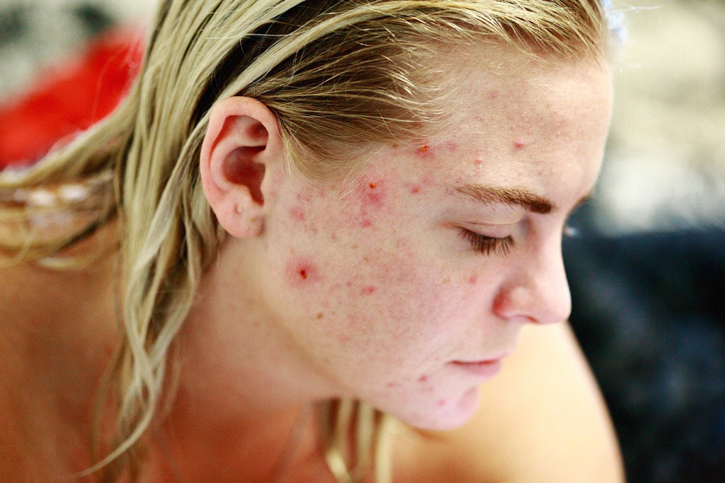 Acne Treatment Using Various Compounded Solutions